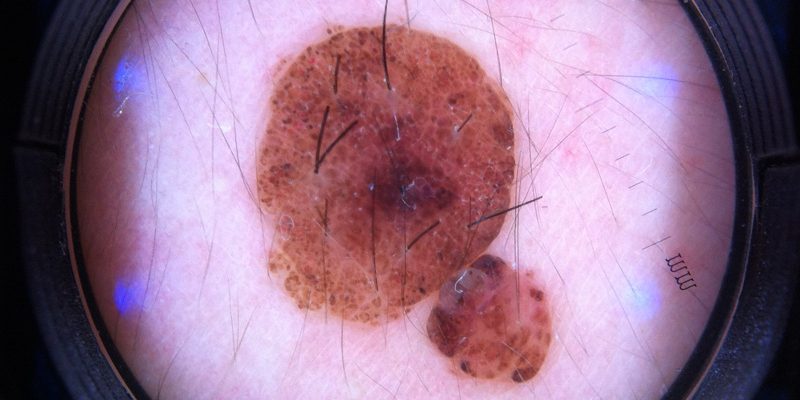 Дерматоскопија – метода за рано откривање на меланомот на кожата