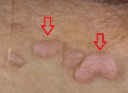 Генитални брадавици (Condylomata acuminate)