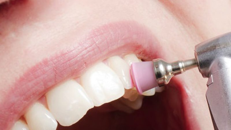 Заблуди и вистини околу редовните професионални чистења на стоматолог – д-р Ана Бундалевска – Александровска
